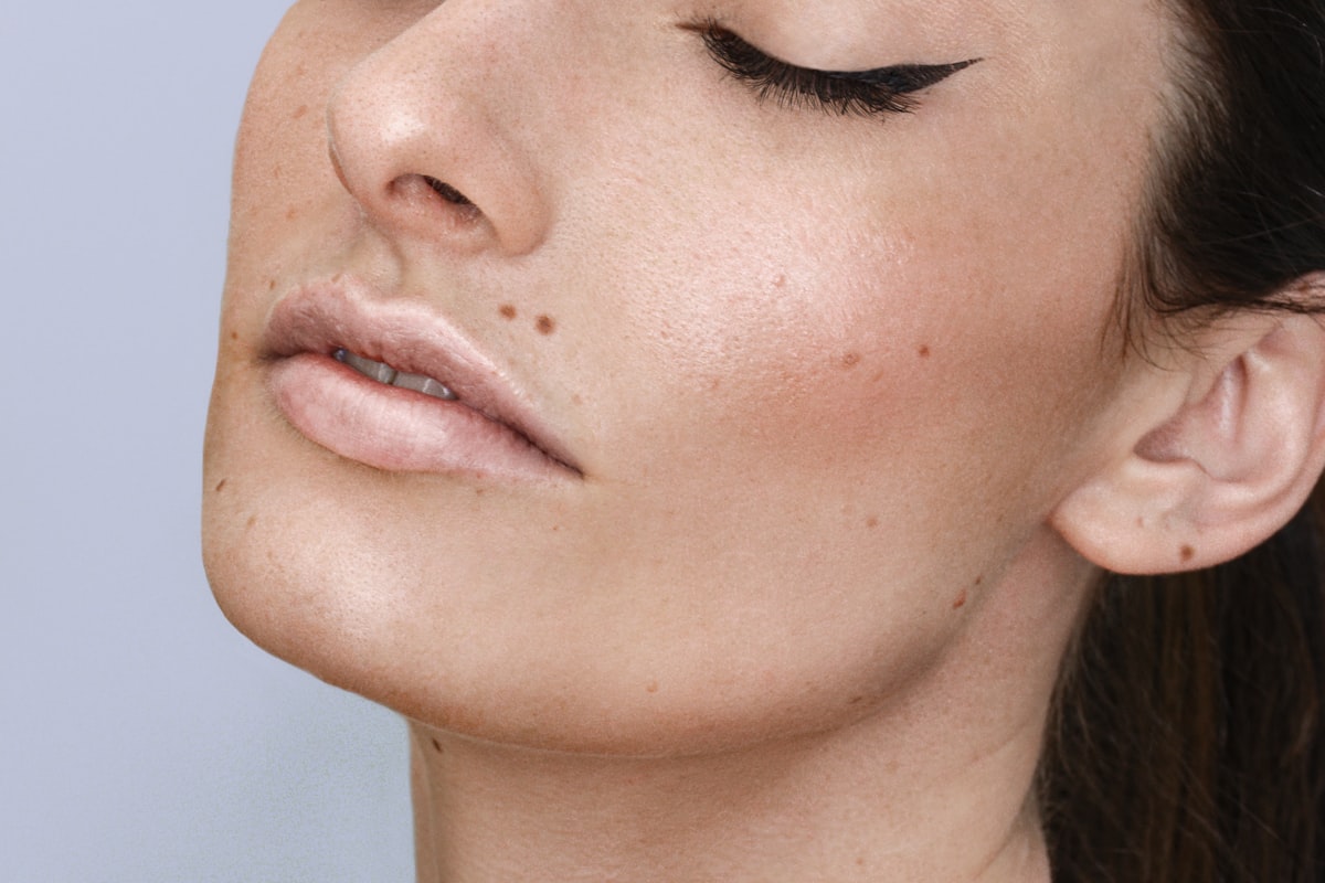 Tratamento e Controle de Melasma no Instituto Ademir Filho